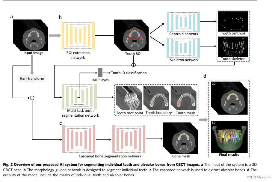 基于人工智能的 CBCT 牙齿及牙槽骨全自动分割系统A fully automatic AI system for tooth and alveolar bone segmentation from