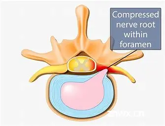 【1】Kaggle赛题解读：RSNA 2024 Lumbar Spine Degenerative Classification 